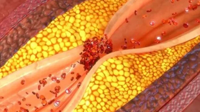 aterosclerose-1539525443575_v2_450x450-960x540